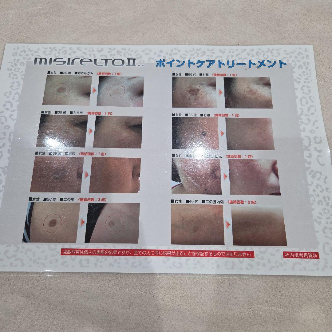 値下げしました！ MISIRELTO II シミケアペン筋膜リフトポレーション