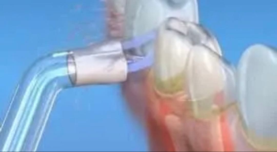 ウォーターフロッサー