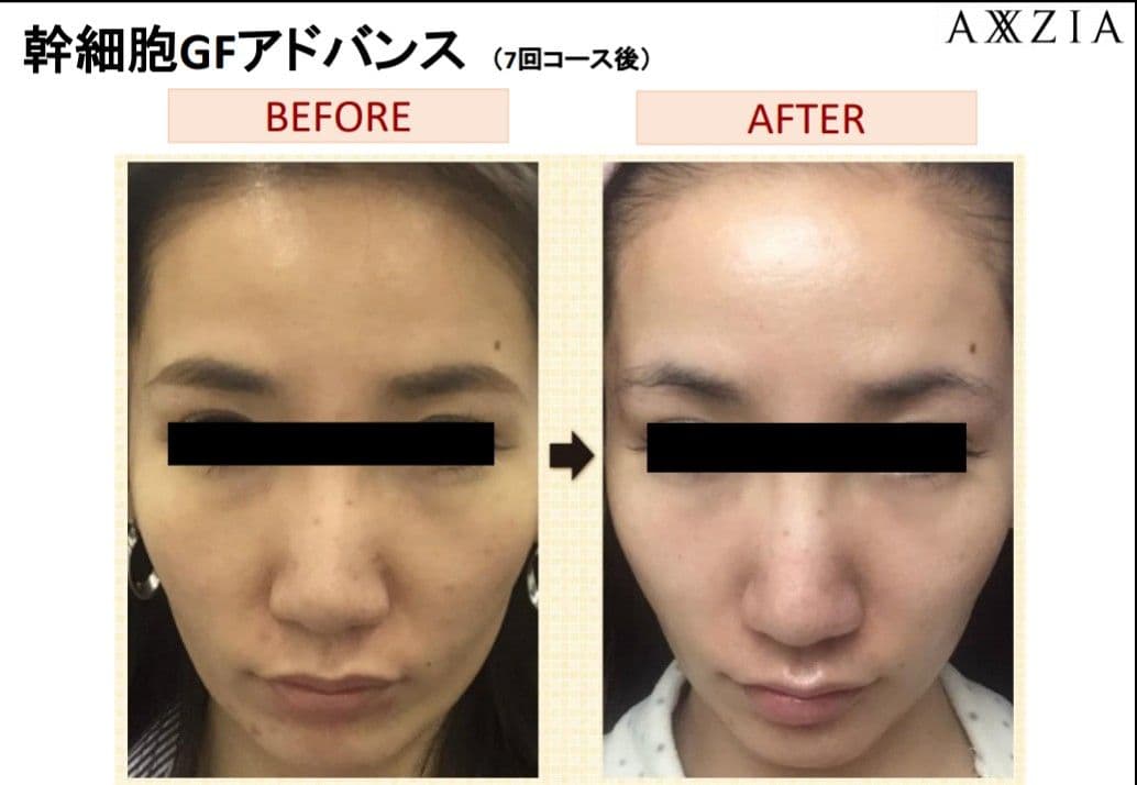 【本物】アクシージア☆GFチャージアドバンス☆美容液導入美肌艶肌水光注射エステ