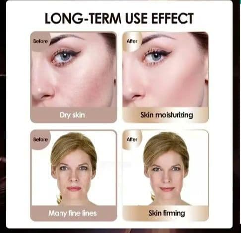 ハイフ ミニハイフ 3.0