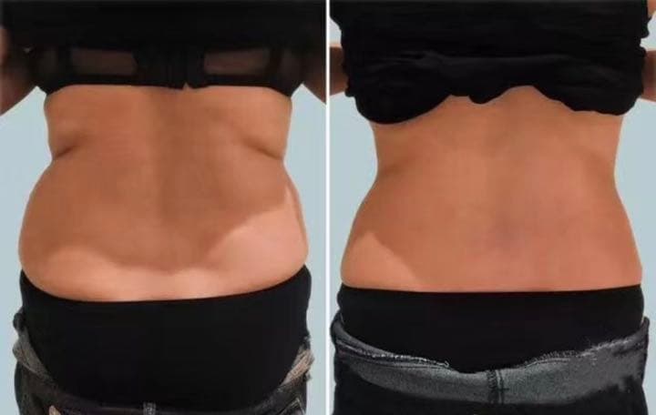 冷凍脂肪溶解 フリーズファット