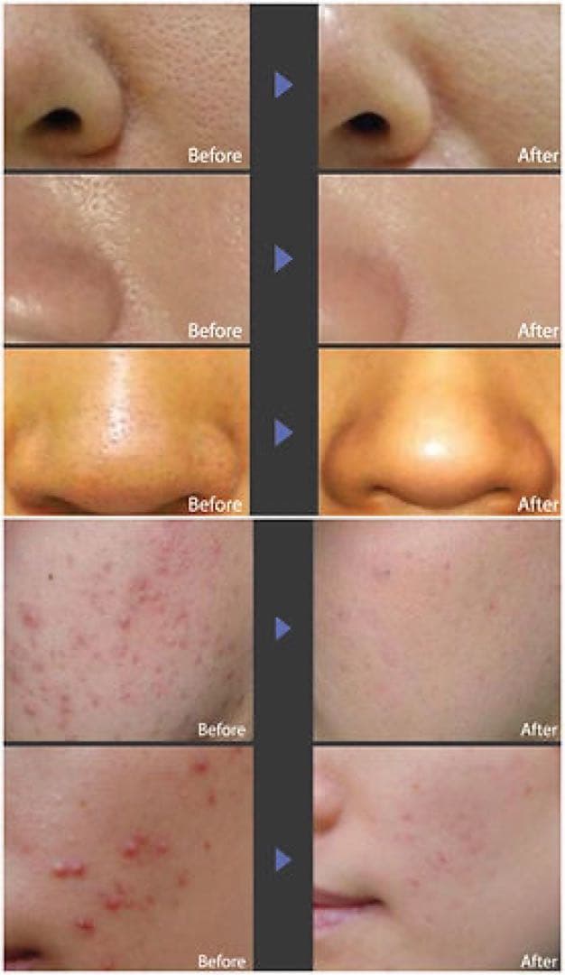 DERMASPA 毛穴洗浄機