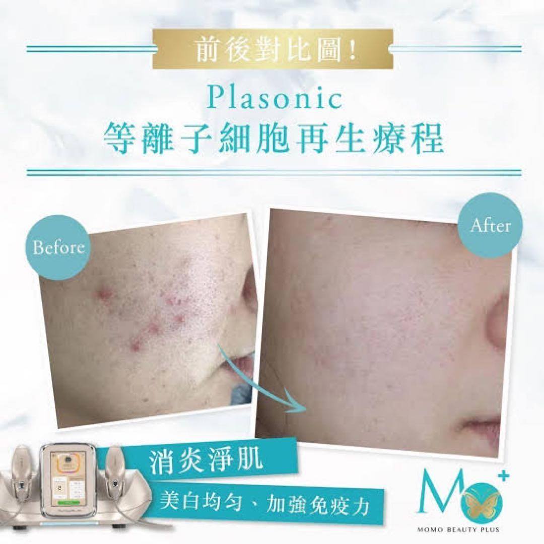 プラズマ plasma 美容　シミ　肝斑　ニキビ　LDM エレクトロポレーション