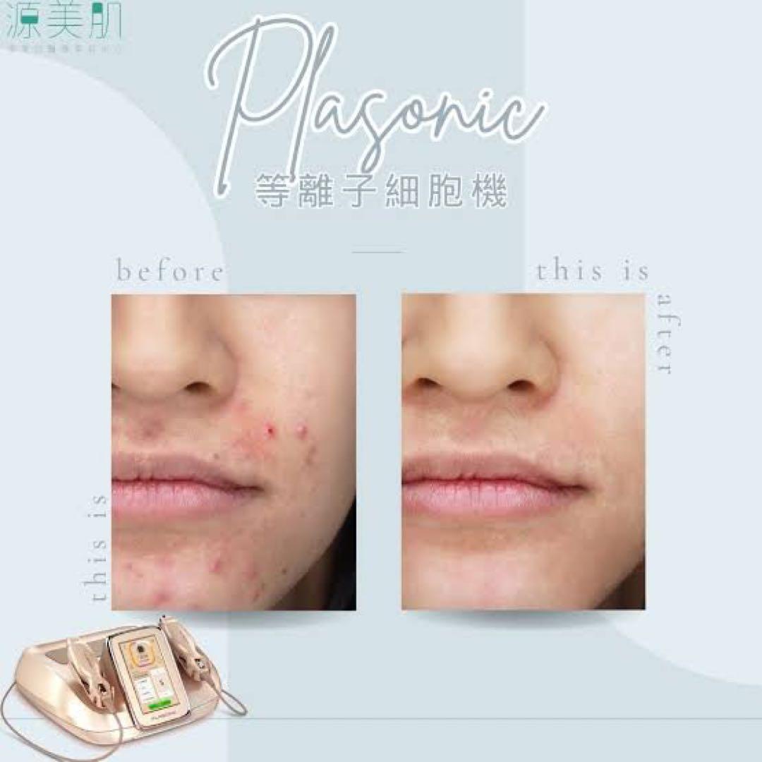 プラズマ plasma 美容　シミ　肝斑　ニキビ　LDM エレクトロポレーション