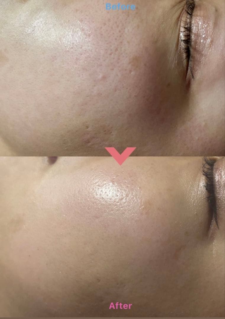 【正規品】プラズマニードルカリファE X美容機器／サロンケア/サロンケア